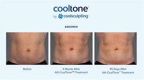 Coolsculpting.